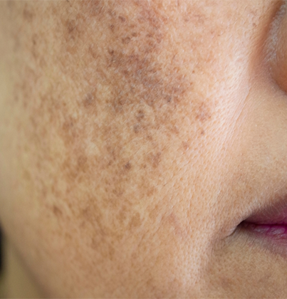 Skin Doctor in Tambaram