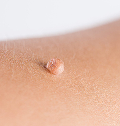 Skin Doctor in Tambaram